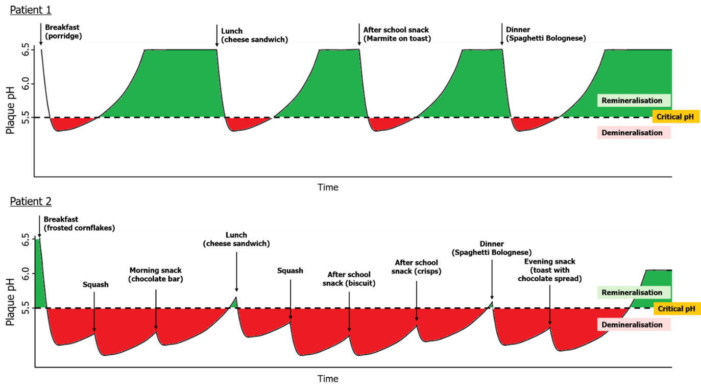 Patient 1 has longer breaks between eating and healthier plaque pH. Patient 2 eats very frequently and has worse plaque pH.