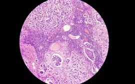 Breast cancer awareness Microscopic image (photomicrograph) of core biopsy for infiltrating (invasive) ductal carcinoma_lower res for web.jpg